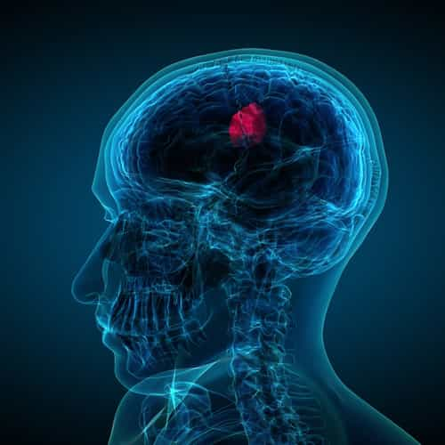 Healing Traumatic Brain Injuries (TBI) with Stem Cell Therapy in Colombia: New Hope for Recovery